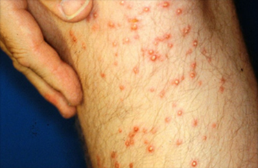 Fire ants Blister